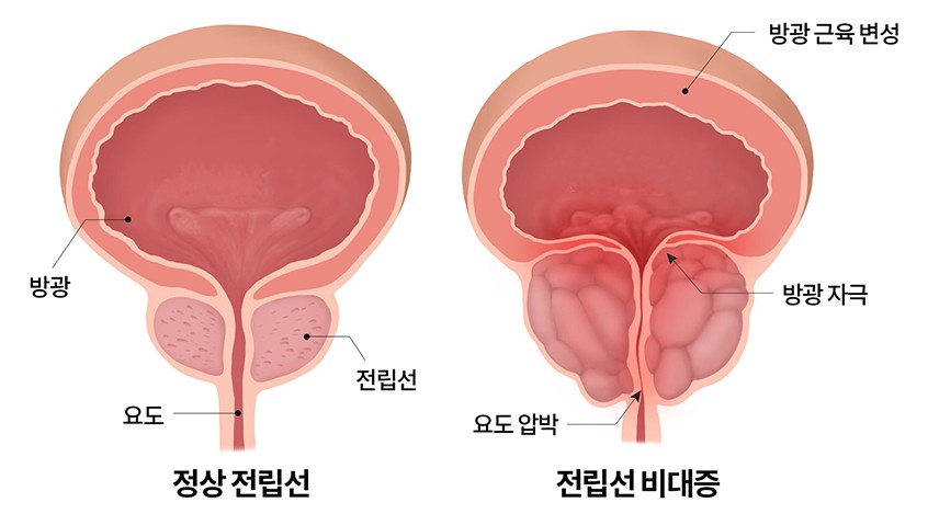 전립선 비대증