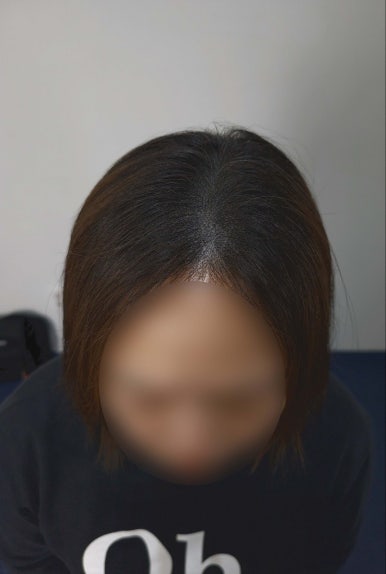 대구두피문신 smp 여성 가르마 탈모 전 후