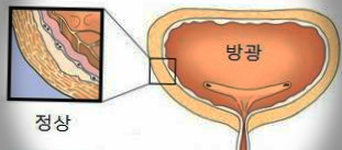  간질성 방광염 증상은 이렇습니다.