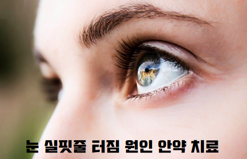 눈 실핏줄 터짐 원인 안약 치료