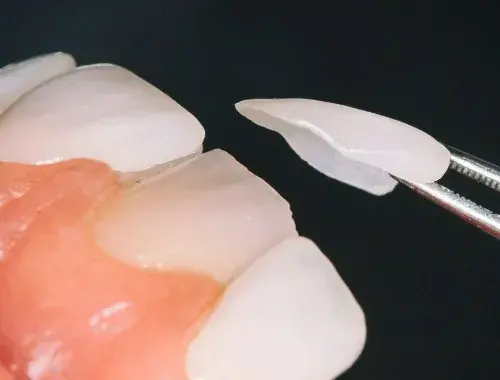 이빨-표면에-부착하는-보철물을-라미네이트라고-합니다.