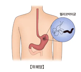 헬리코박터균 제균 치료 치료방법 성공률_3