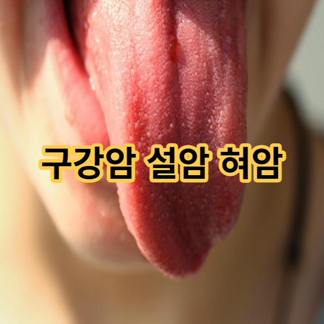  구강암 설암 혀암 초기 증상과 원인에 따른 치료법