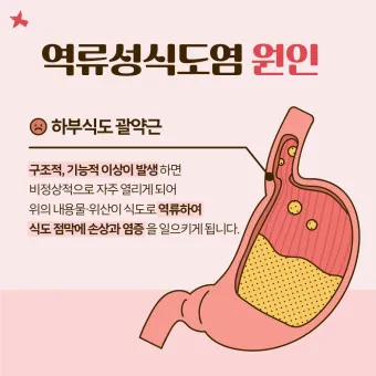 역류성 식도염 원인 초기증상 예방하는 방법_7