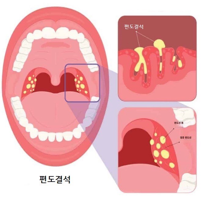 편도결석