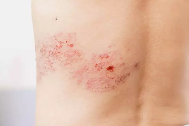 대상포진 초기증상 치료방법