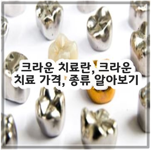 크라운 치료란&#44; 크라운 치료 가격&#44; 종류 알아보기