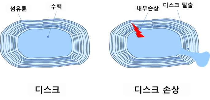 디스크 형태와 손상