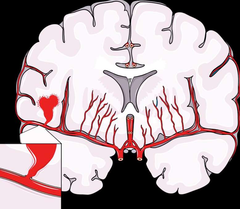 뇌혈관질환1