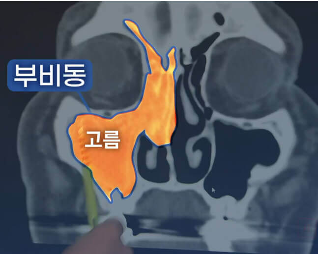  치성 상악동염의 임플란트 축농증 위험 주의보