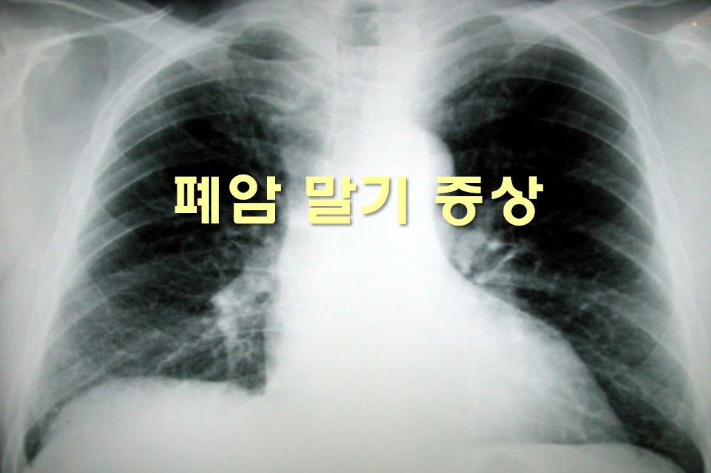  폐암 말기 증상과 폐암 수술 후 관리 방법