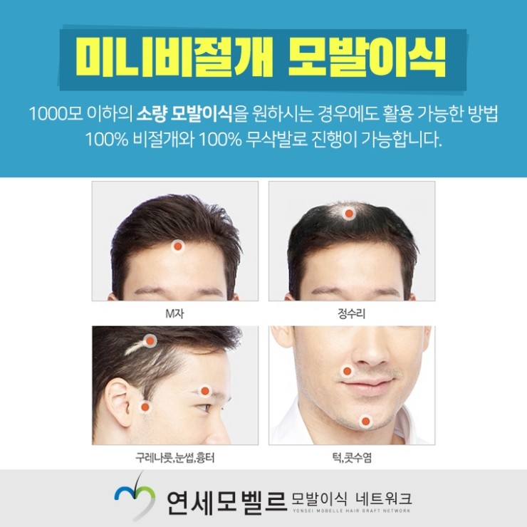 효과적인 치료를 원한다면 대전탈모 더욱 3