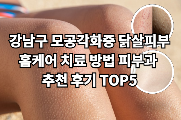 강남구 모공각화증 닭살피부 홈케어 치료 방법 피부과 추천 후기 TOP5