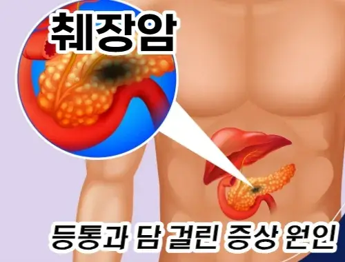 췌장암도-등에-담이-온-듯한-증상을-발생시킬-수-있습니다.