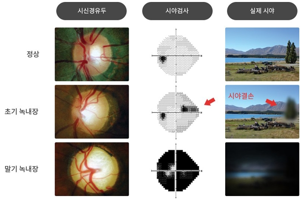  10대도 나타나는 실명 유발하는 녹내장 대표 증상 6가지