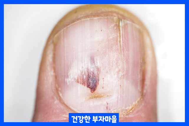 발톱무좀 관리 방법