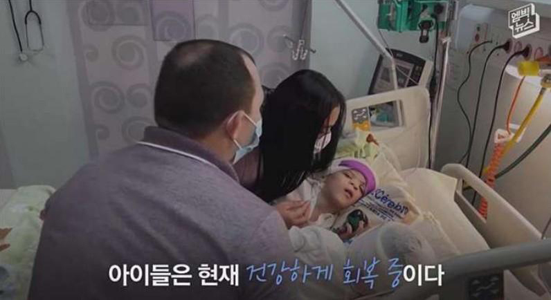  샴쌍둥이 머리 분리 수술