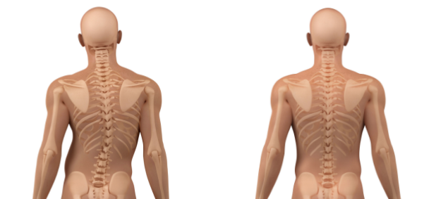 왼쪽은 척추측만증&#44; 오른쪽은 정상 척추