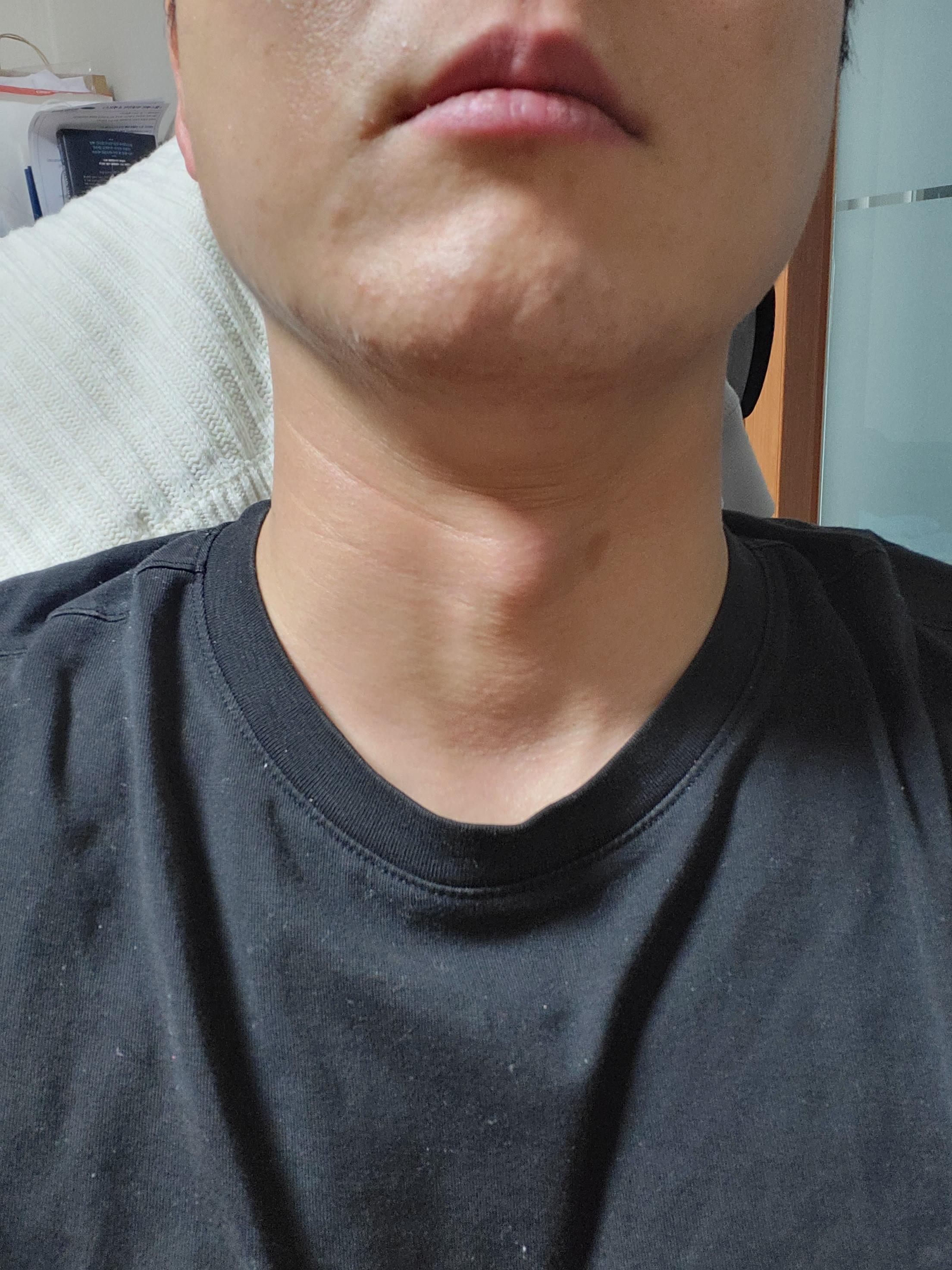 [리뷰] 서울 남자 레이저제모 3회차 후기