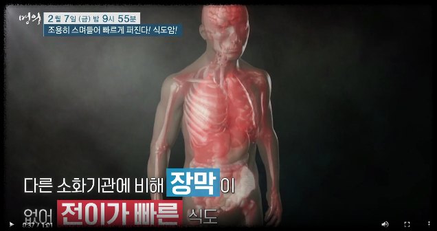 식도암증상-식도암