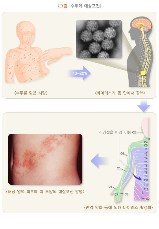  대상포진 원인, 진단, 증상, 치료법 및 예방법