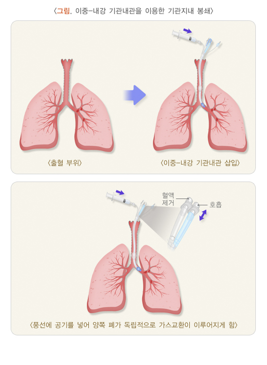 이중-내강 기관내관을 이용한 기관지 내 봉쇄