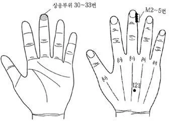 두통 수지침 편두통 혈자리_7