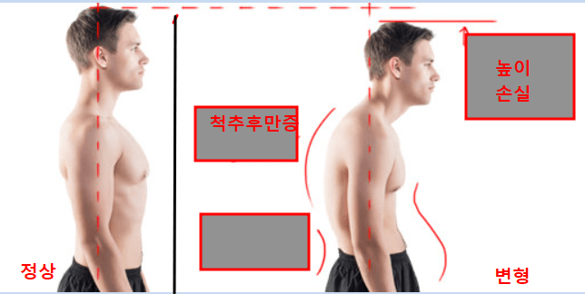 정상 척축 및 변형된 척추 사진