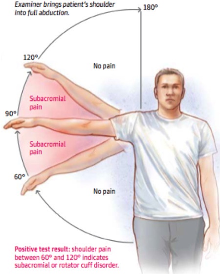 어깨 충돌증후군이 있으면 일정 각도를 넘어서면 통증이느껴진다