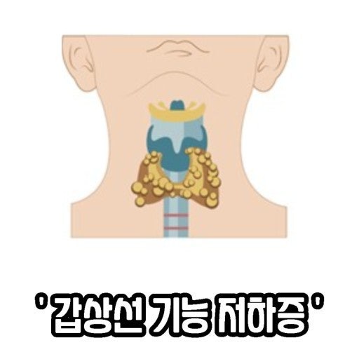 갑상선기능저하증의 증상과 원인