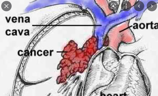 대부분 cancer 가 SVC 를 직접적으로 누르면서 생긴다.