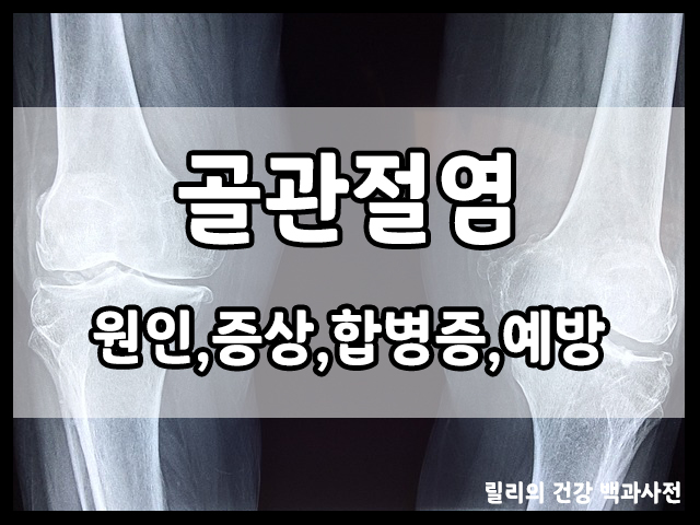  골관절염 : 골관절염의 증상, 골관절염 원인, 합병증, 골관절염 예방 방법