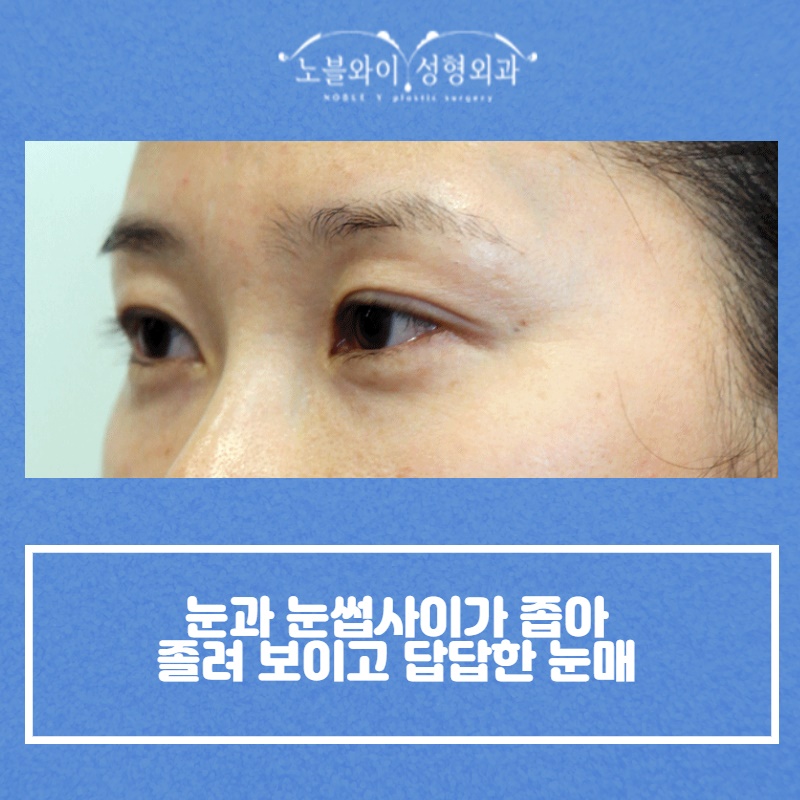  노블와이 이마눈썹거상술 2030대도 많은이유