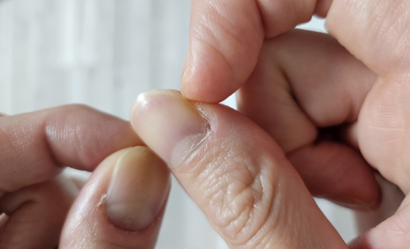  강박 장애(OCD)의 원인 : 손이나 손톱을 뜯는 이유