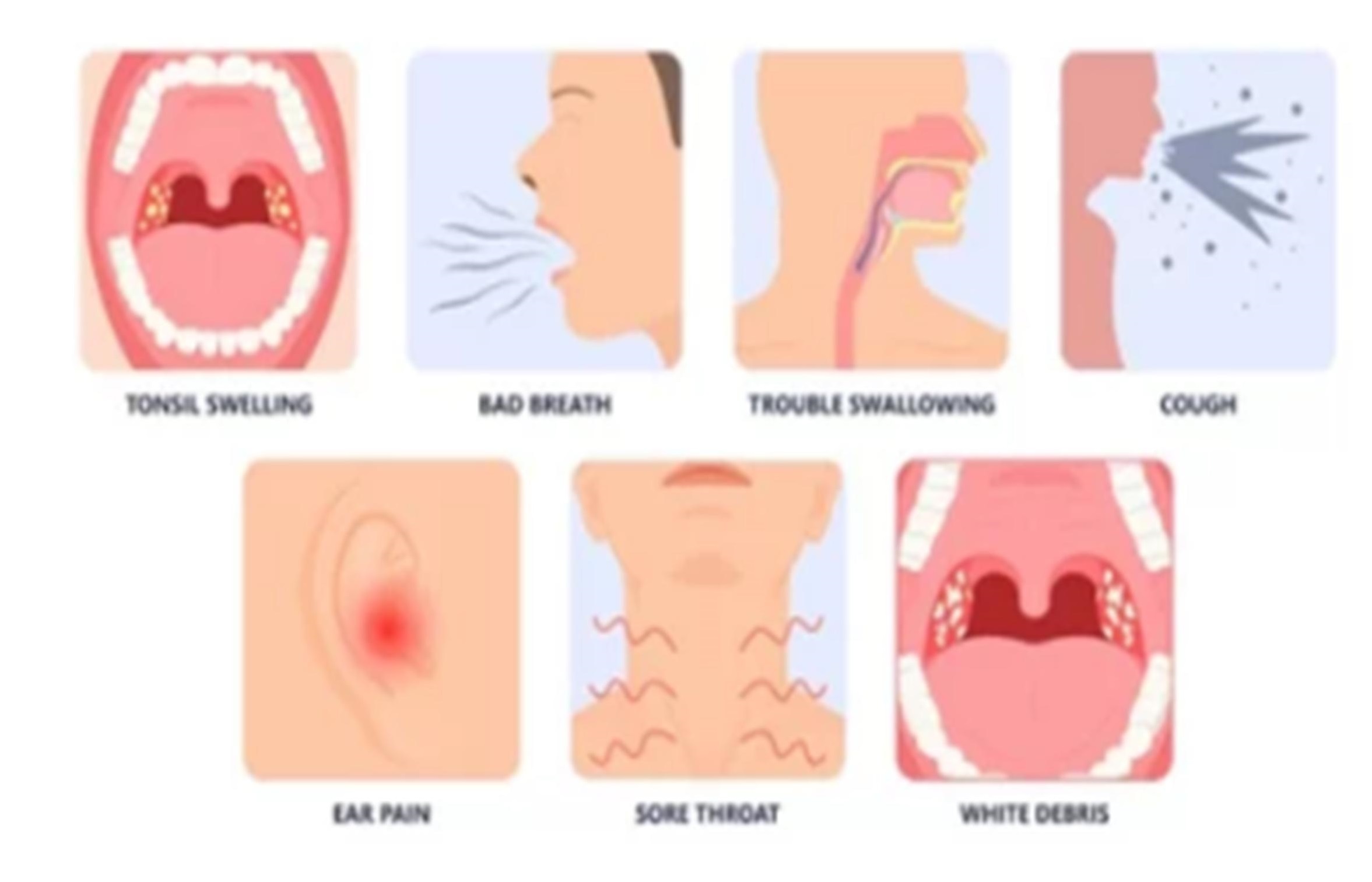 편도결석으로 나타나는 증상들 그림