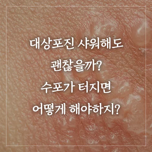 대상포진-샤워해도-괜찮을까?