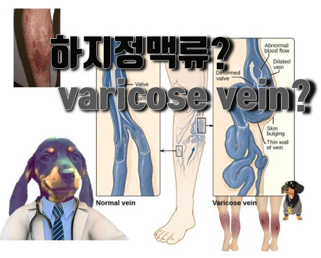  하지정맥류란?