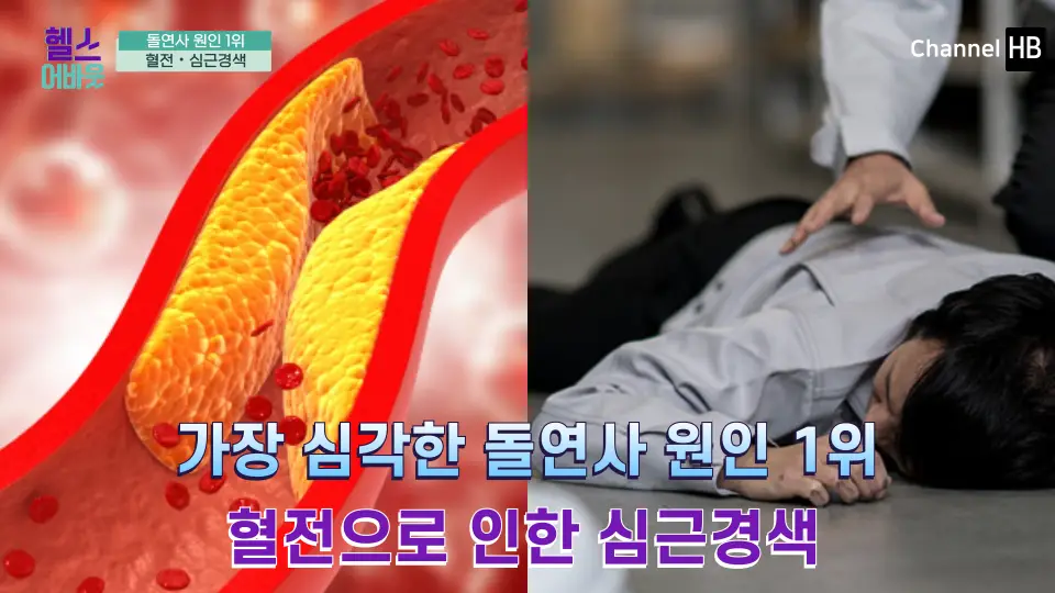 혈전용해제 나토키나제