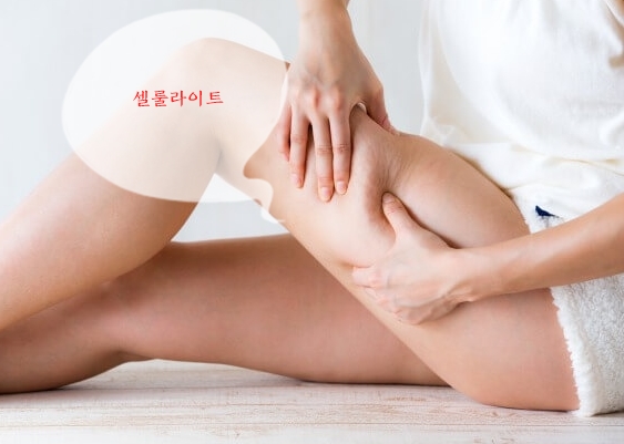  셀룰라이트가 대체 뭘까요? 다이어트로 셀룰라이트를 해소하자!