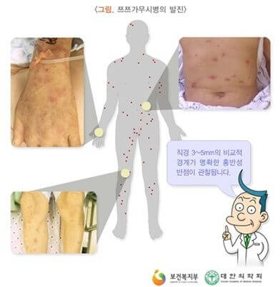 쯔쯔가무시 증상