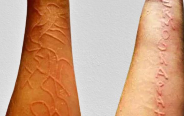 피부 각화증 사진