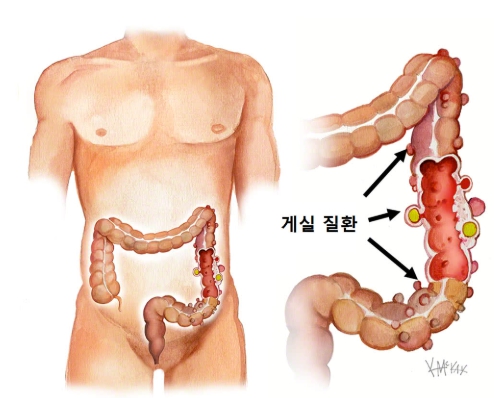 게실염 