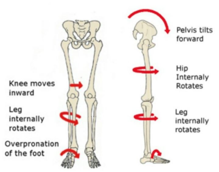 발의 틀어짐으로 인해서 하지 전체가 틀어지고 골반의 틀어짐을 만드는 그림