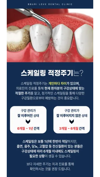 스케일링 후 양치 통증 음식_26