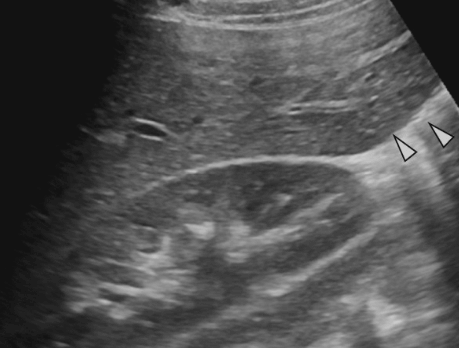 Liver anatomy & Normal variation :: ultrasound study