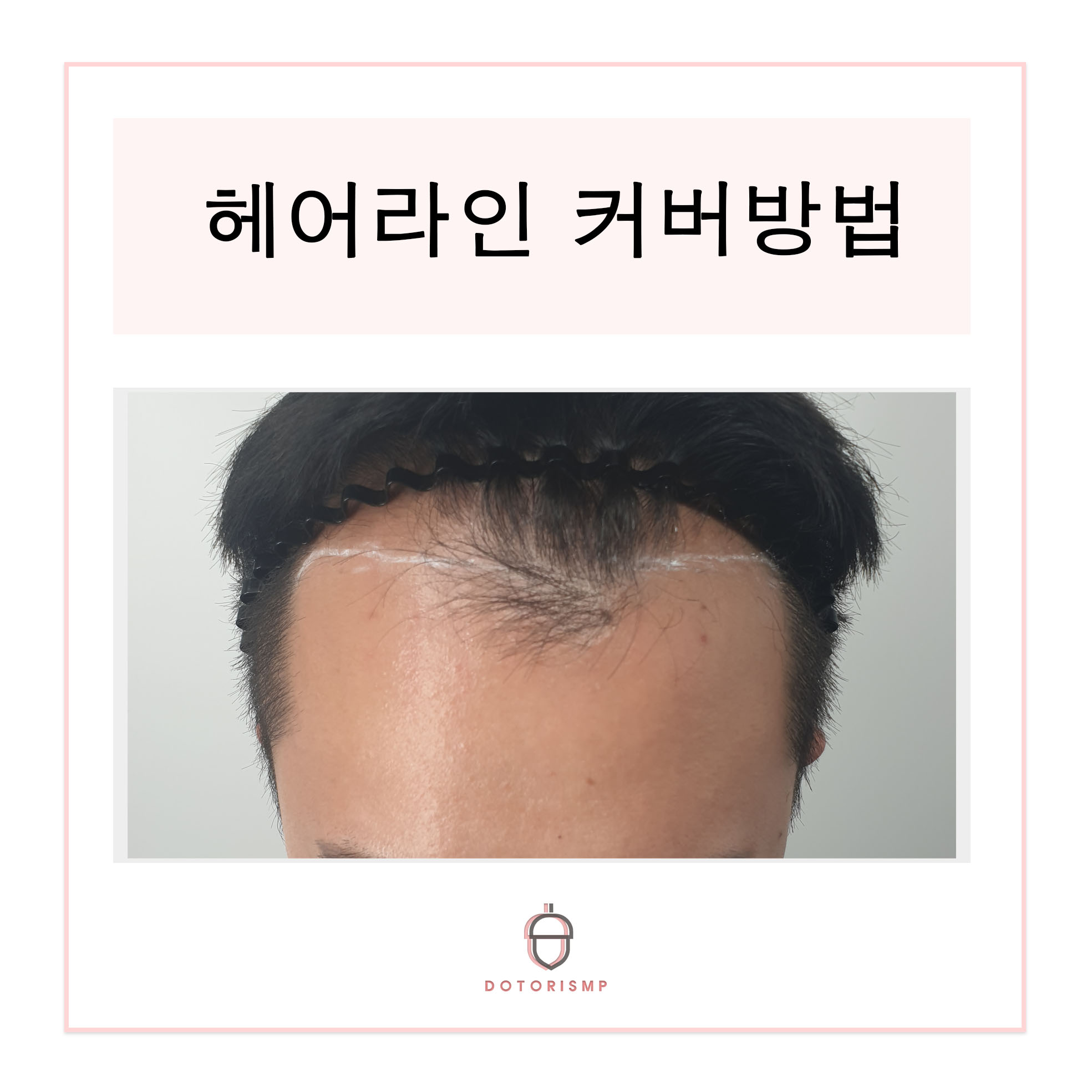  [부산두피문신] M자 헤어라인 커버는 이렇게 하면되요