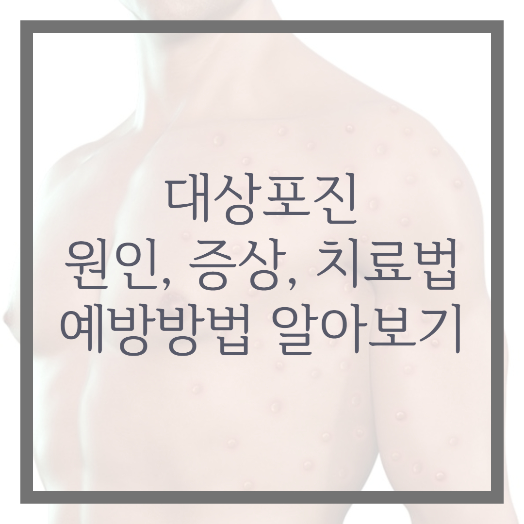 대상포진