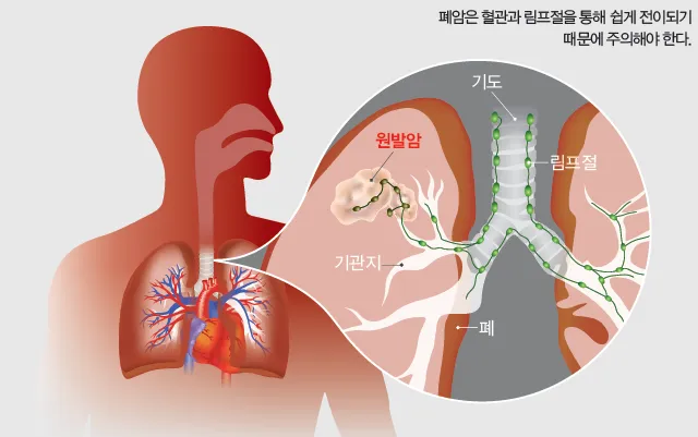 폐암 초기증상