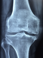 무릎 관절에 좋은 음식