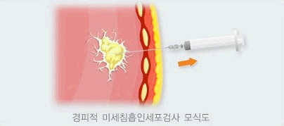 경피적 미세침흡인세포검사 모식도